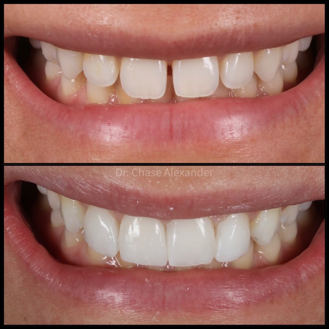 Composite Veneers Westwood, KS Westwood Aesthetic Dentistry